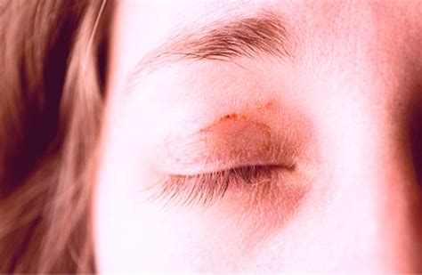 Itchy Eyelids Causes And Treatment Hubpages