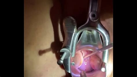 Que Es Una Biopsia De Cuello Uterino Xxx Porn Videos Que Es Una