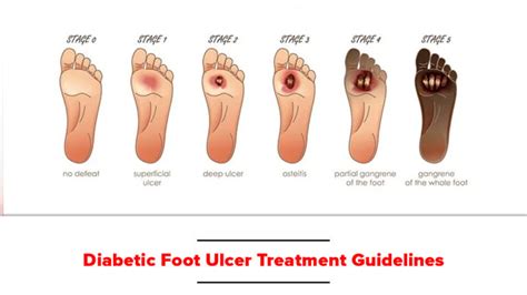 Diabetic Foot Ulcer Treatment Guidelines Bioflex Pakistan