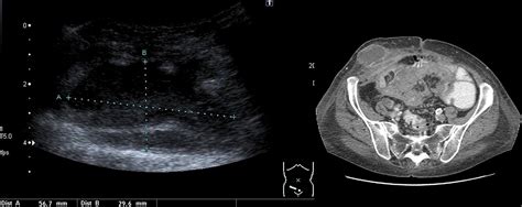 Ultrasound Of The Abdominal Wall What Lies Beneath Clinical Radiology