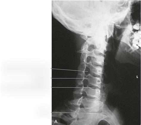X Ray Anatomy Ap Axial Oblique C Spine Diagram Quizlet