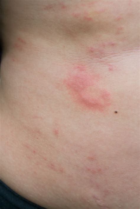 Hive Treatment Washington Dc Black And Kletz Allergy