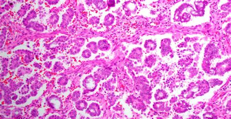 Types Of Ovarian Tumors Ovarian Cancer Johns Hopkins Pathology