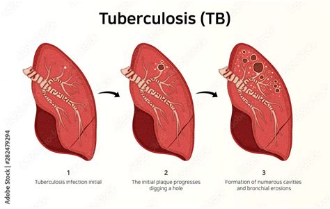 Lung Infected With Tuberculosis Latent Infection Cavitary