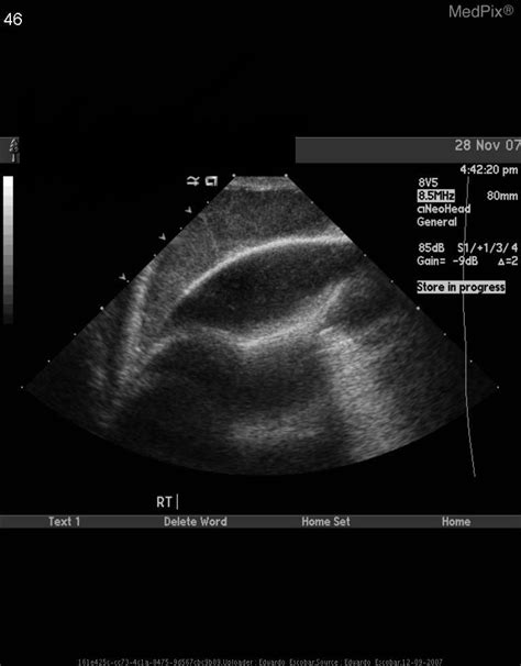 Cephalohematoma Ultrasound