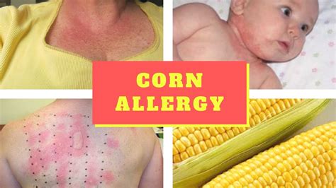Corn Allergy Symptoms Causes Symptoms And Pictures Of Corn Allergy