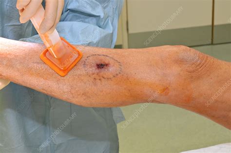 Squamous Cell Carcinoma Skin Excision Stock Image C0550484