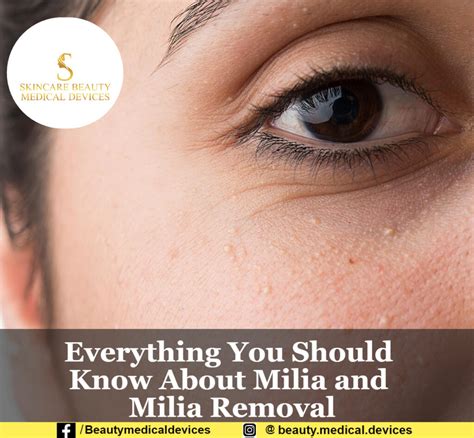 Everything You Should Know About Milia And Milia Removal