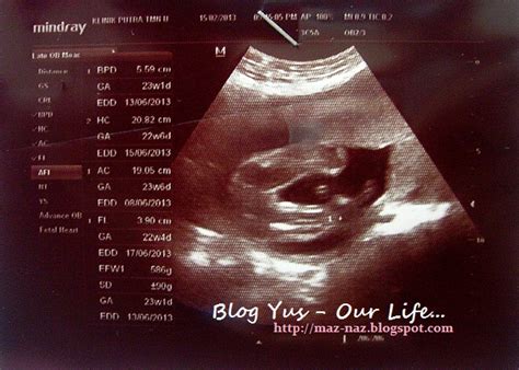 Alhamdulillah 37 Hari Ini Scan Baby Blog Yus Our Life