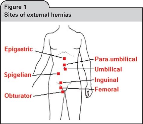 Figure 1 From Frequency Of Abdominal Wall Hernias Is Classical