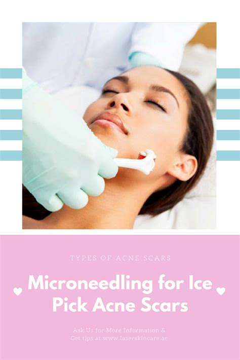 Know Cemsim Ice Pick Acne Scar Treatment