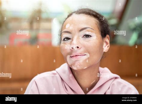 Black African American Woman With Vitiligo Pigmentation Skin Problem