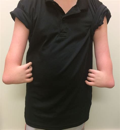 Radial Deficiency Doing Fine Congenital Hand And Arm Differences