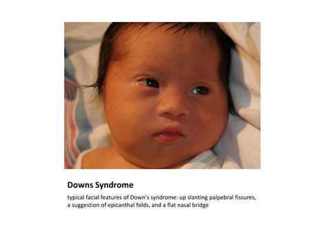 Another common manifestation is the short, flattened bridge of the nose of the child. PPT - NEWBORN & 6 WEEK CHECK PowerPoint Presentation - ID:455681