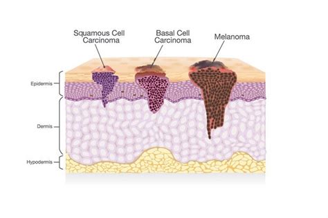 Cáncer De Piel Tipos Causas Síntomas Y Prevención