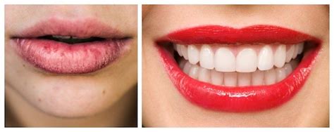 What Causes Dry Skin Around The Lips