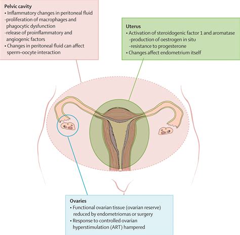 Endometriosis And Infertility Pathophysiology And Management The Lancet