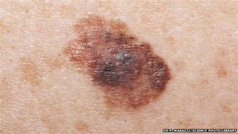 Hospitals See Rapid Rise In Skin Cancer Bbc News