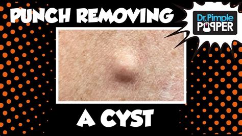 A Punch Removal Of A Cyst With Dr Pimple Popper Pimple Popping Videos