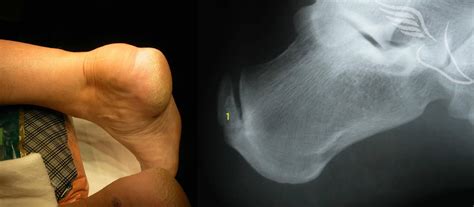 Haglunds Deformity The Foot And Ankle Clinic