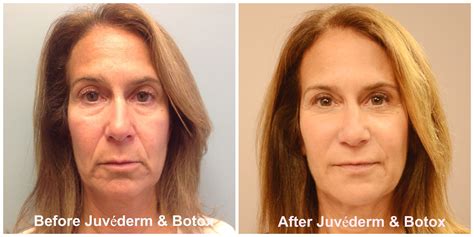 60 Year Old Ginnys Before And After A Liquid Facelift Using Botox