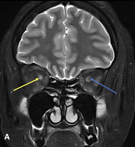 Optic Neuritis On Diagnosis Mri Online