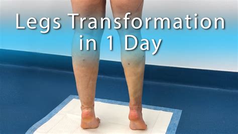 Cankles And Knees Ankles Calves Legs Lipedema Treatment High Def