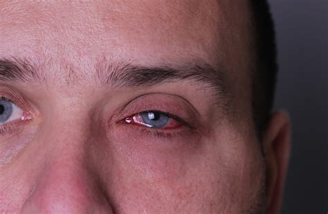 Invasive Fungal Sinusitis Can Threaten Vision Health Optometry Advisor