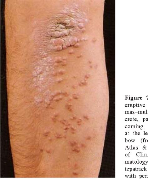 Figure 13 From Skin Manifestations Of Liver Diseases Semantic Scholar