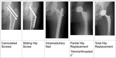 Hip Fracture Dr Jonathan R Danoff Md Orthopedic Surgeon