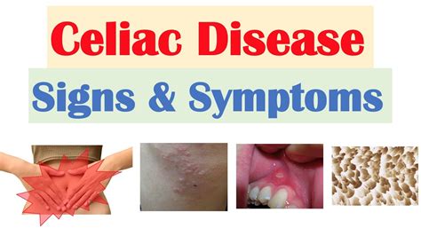 Celiac Disease Sign And Symptoms Medical Estudy Pelajaran