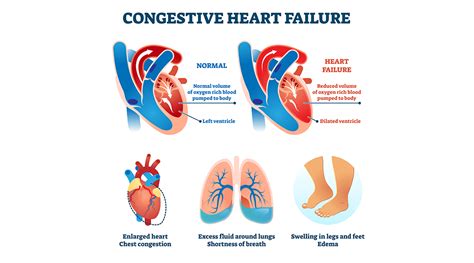 Congestive Cardiac Failure Dr Raghu