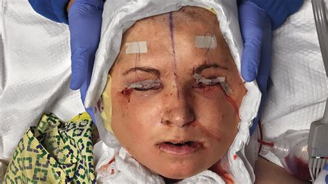 Photographing The Youngest Face Transplant In Us History