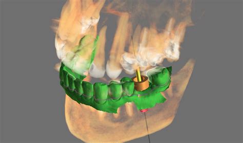 Marietta Ga 3d Guided Dental Implants East Cobb Dental Implant Placement