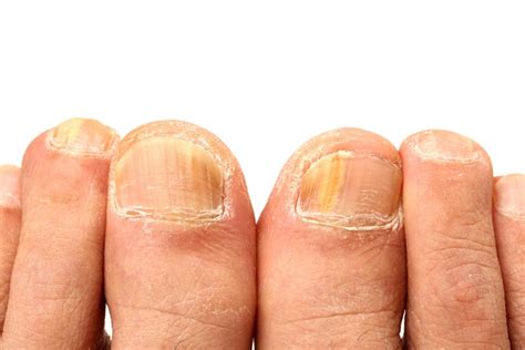 Candidiasis Of The Skin And Nails Symptoms Treatment And Prevention
