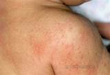 Skin Heat Rash Treatment Images
