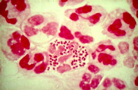 Infection may involve the genitals, mouth, or rectum. Neisseria gonorrhoeae - JungleKey.fr Image #50