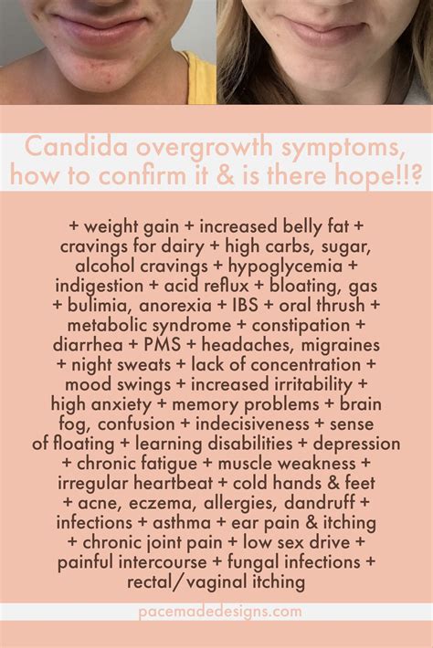 Candida Overgrowth Candida Diet Most Depressing Diet Ever — Xo