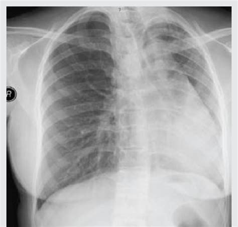 Chest X Ray Posterior Anterior View Shows Hypoplastic Left Lung