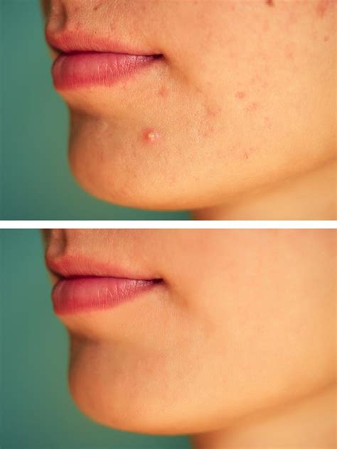 Drformulas Best Acne Treatment To Get Rid Of Hormonalcystic Acne And Scars
