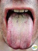Photos of Tongue Fungus Home Remedies