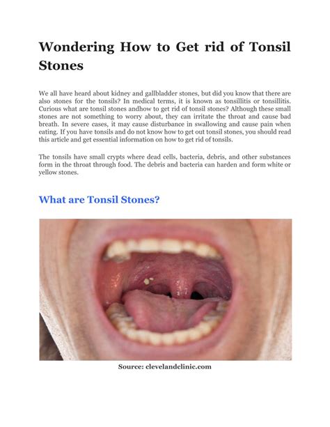 Ppt Wondering How To Get Rid Of Tonsil Stones Powerpoint Presentation