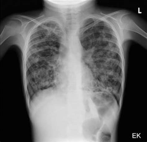 Cystic brosis (cf) is the most lethal genetic disorder in the caucasian population. Cystic Fibrosis: Basic Diagnostic Features Of ...