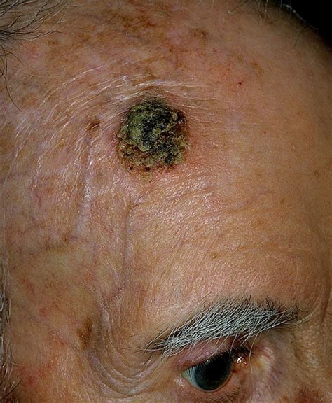 Signs Of Skin Cancer Pictures 48 Photos Images Illnessee Com