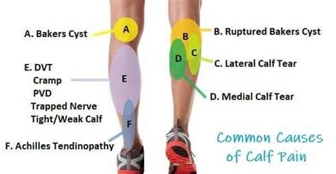 Calf Muscle Pain You Are Not Sure What Is C Dr Ayaz Physiotherapy