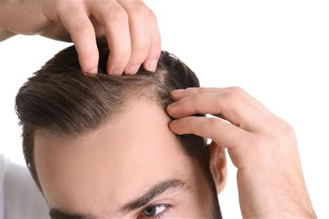 Dandruff On Bald Head Tips And Advices Head And Shoulders In