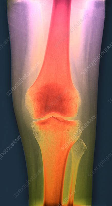 Healthy Knee X Ray Stock Image P1160518 Science Photo Library