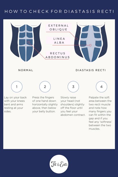 How To Check For Diastasis Recti Diastasis Recti Diastasis