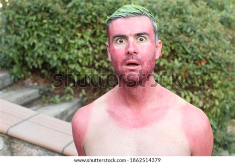 Get Sunburnt Over 39 Royalty Free Licensable Stock Photos Shutterstock