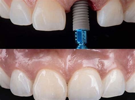 Single Tooth Implant Delhi India Single Dental Implant Cost Delhi India